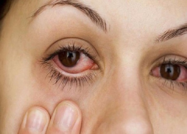 Đau mắt đỏ là một trong những vấn đề phổ biến của mắt
