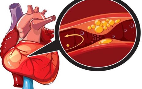 Bệnh mạch vành là một trong những bệnh về tim mạch đáng chú ý