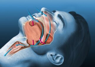 Hội chứng ngưng thở khi ngủ là gì?