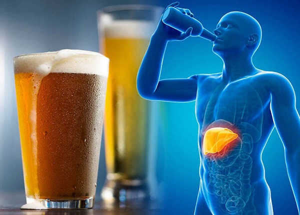 Rượu bia là nguyên nhân số một gây bệnh gan nhiễm mỡ