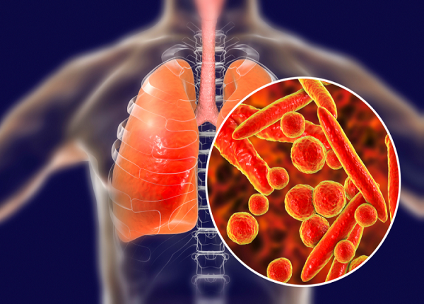 Bệnh lao màng phổi có thể gây ra hậu quả nghiêm trọng