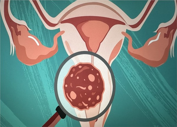 Ung thư cổ tử cung là nguyên nhân phổ biến gây tử vong cho phụ nữ
