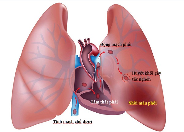 Thuyên tắc phổi là một trong những bệnh lý có tỷ lệ tử vong cao