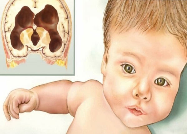 Các dấu hiệu nhận biết não úng thủy ở trẻ