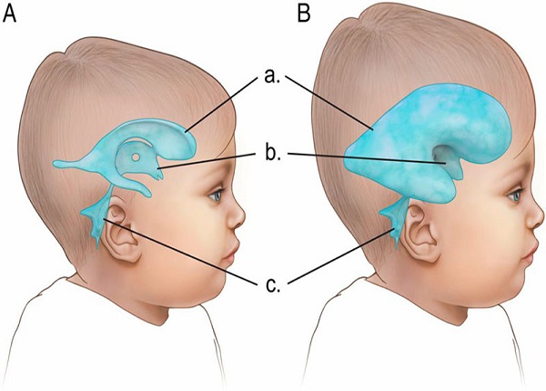 Não úng thủy là một loại rối loạn não thường xuất hiện ở trẻ nhỏ