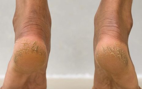 Nứt gót chân tuy không nguy hiểm nhưng vẫn có thể gây ảnh hưởng đến cuộc sống hàng ngày