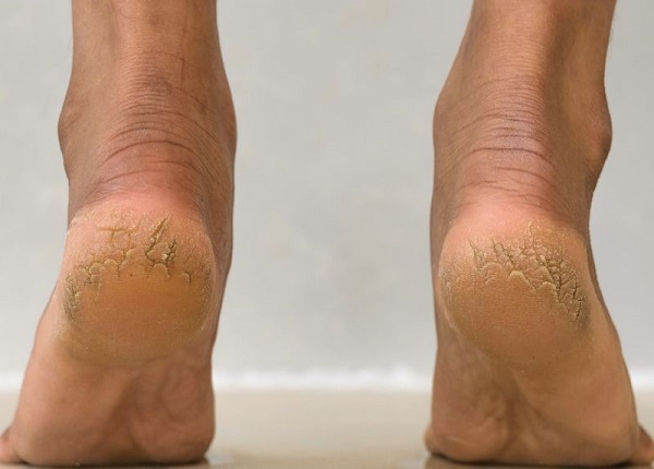 Nứt gót chân tuy không nguy hiểm nhưng vẫn có thể gây ảnh hưởng đến cuộc sống hàng ngày