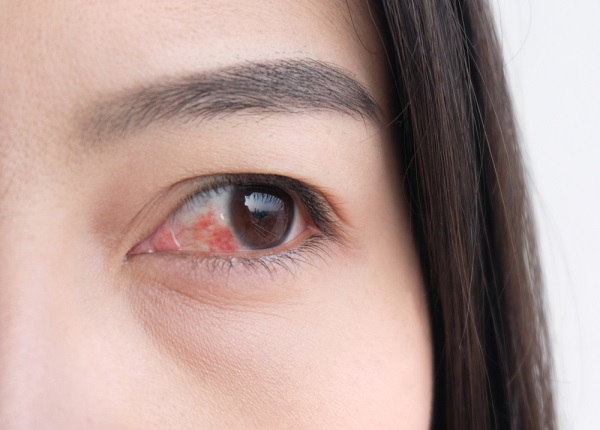 Viêm kết mạc là vấn đề về mắt phổ biến