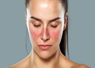 Lupus ban đỏ là bệnh lý tự miễn nguy hiểm