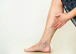 Suy giãn tĩnh mạch chi dưới gây ảnh hưởng đến sức khỏe và chất lượng cuộc sống