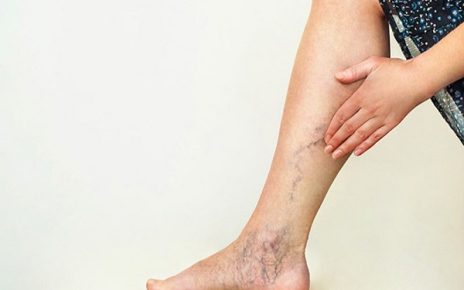 Suy giãn tĩnh mạch chi dưới gây ảnh hưởng đến sức khỏe và chất lượng cuộc sống