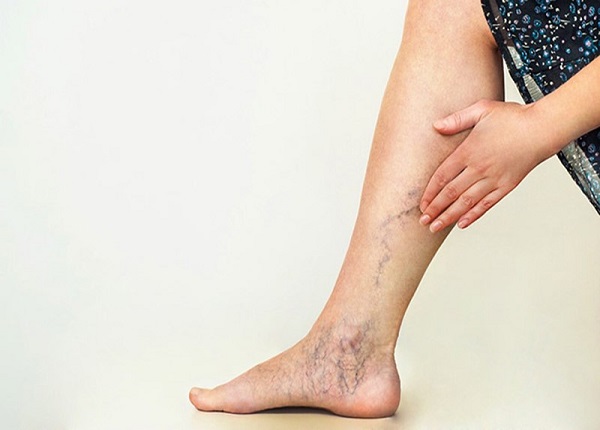 Suy giãn tĩnh mạch chi dưới gây ảnh hưởng đến sức khỏe và chất lượng cuộc sống